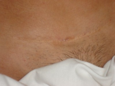 notice the difference in the depth and overall appearance of scar notice the difference in the depth and overall appearance of scar
